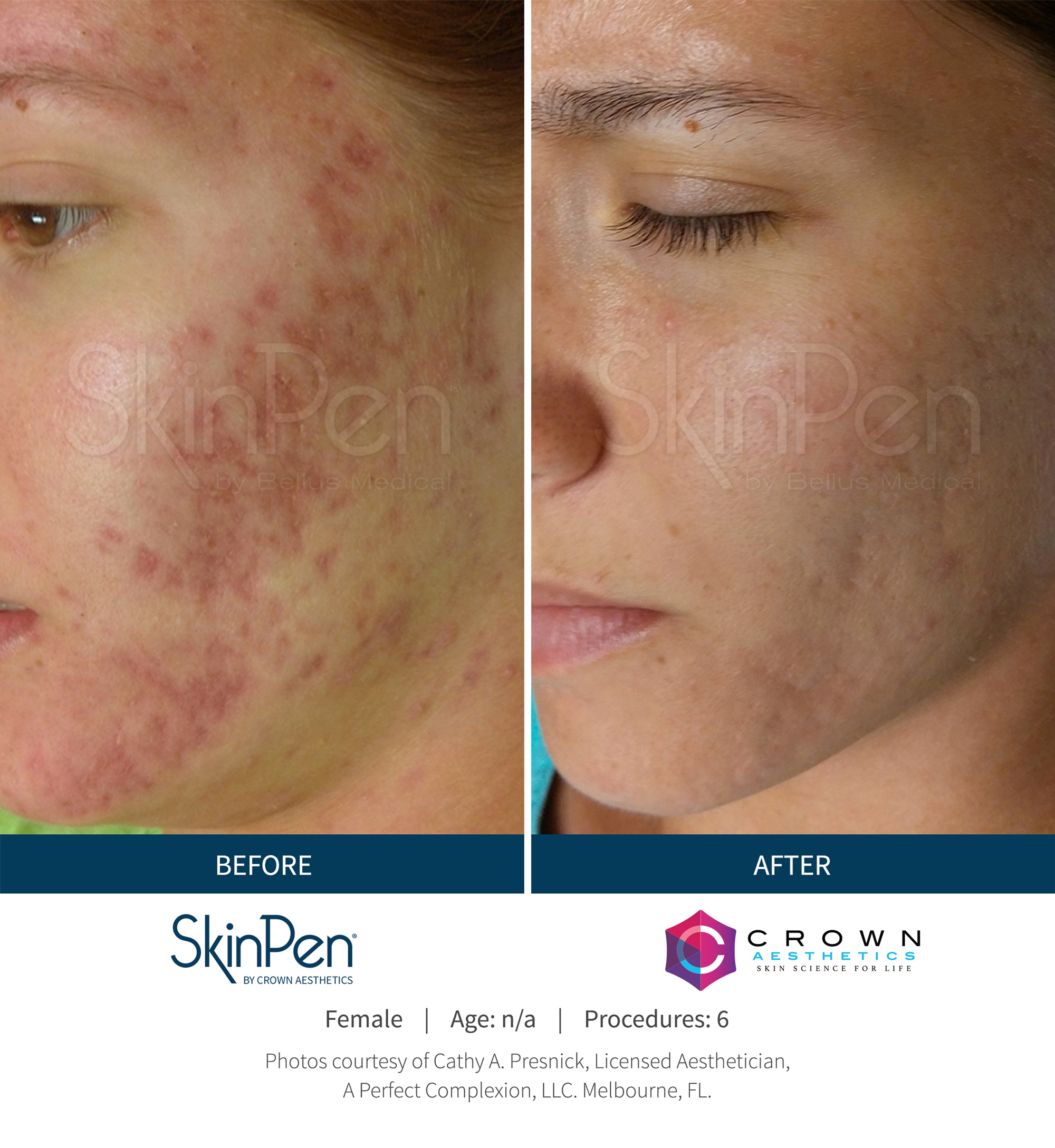 Skin Pen Glendale Microneedling Los Angeles PRP AntiAging Irvine