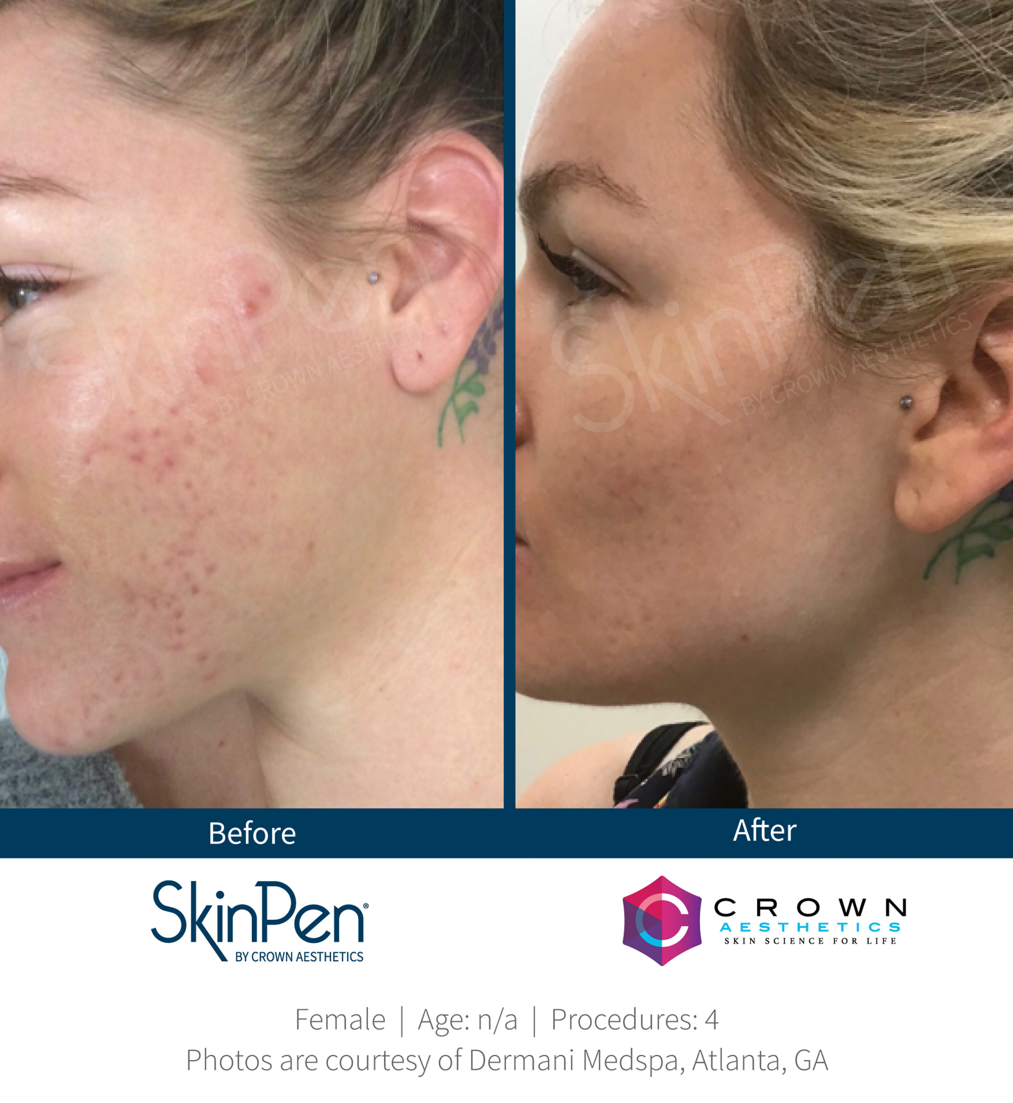 top 90+ Pictures skin pen before and after photos Sharp